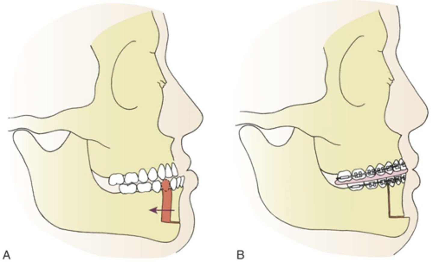 <p>- cut and reposition the bone segment containing the anterior teeth (the anterior alveolar segment) of the upper or lower jaw.</p><p>- used to correct dental and jaw alignment issues, such as protruding or receding teeth,</p><p>- can be performed as an isolated surgery or as part of a larger orthognathic (jaw) surgery.</p><p>- involves cutting the bone both horizontally and vertically, repositioning the tooth-bearing segment, and securing it with plates and screws.</p>