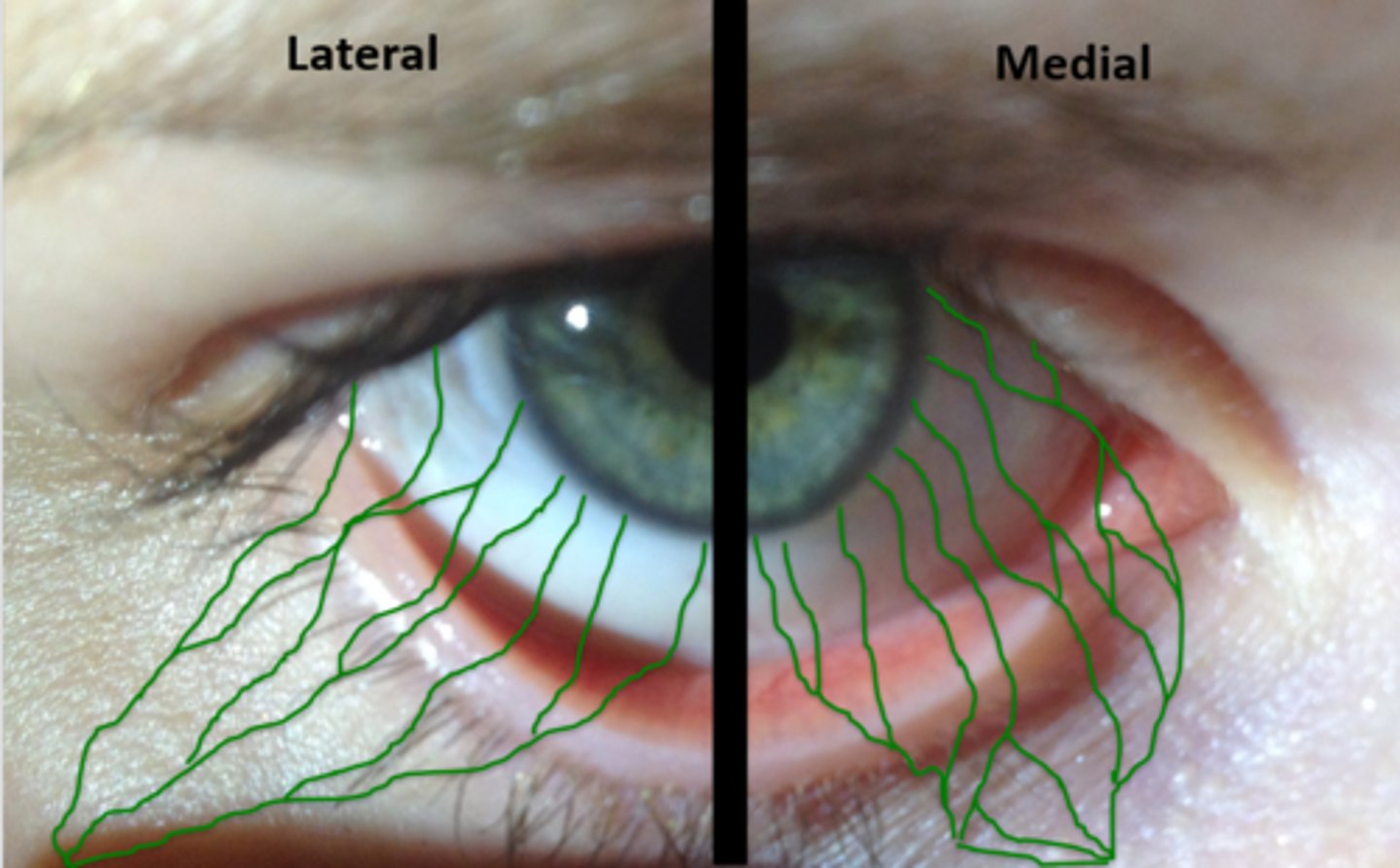 <p>involved lymph will drain to the preauricular lymph nodes (lateral) or submandibular lymph nodes (medial).</p>