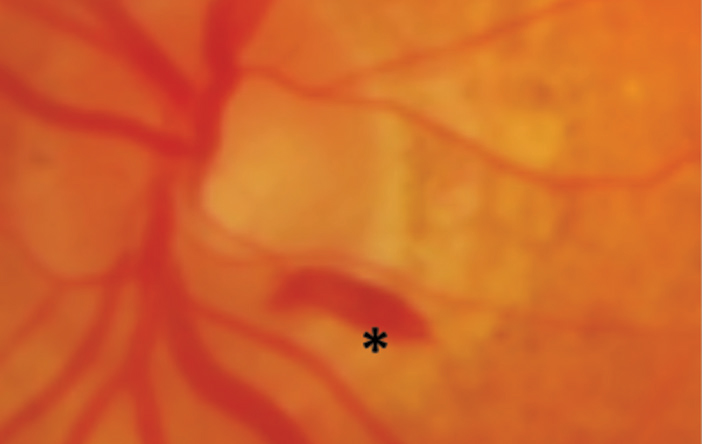 <p>represent bleeding from the inner capillary network of the retina</p>