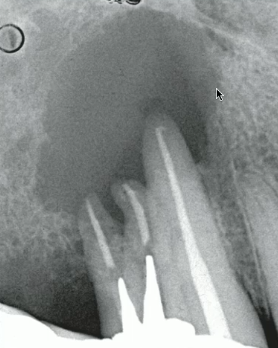 <p>ill defined/ relatively well defined with irrregular NON-corticated <strong>INVASIVE</strong> border</p>