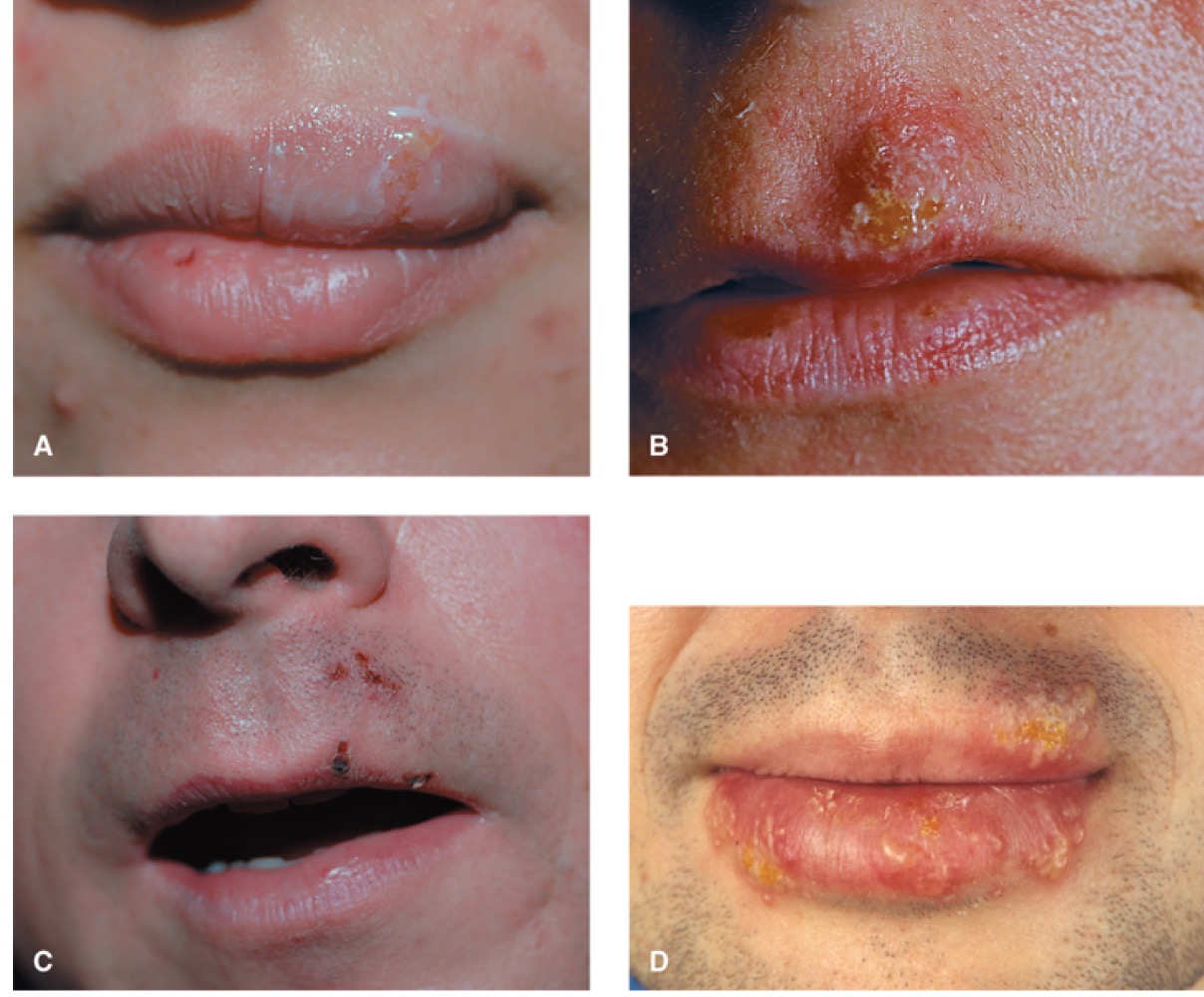 What is this?

A. Shingles

B. Small pox

C. Herpes

D. Jaundice