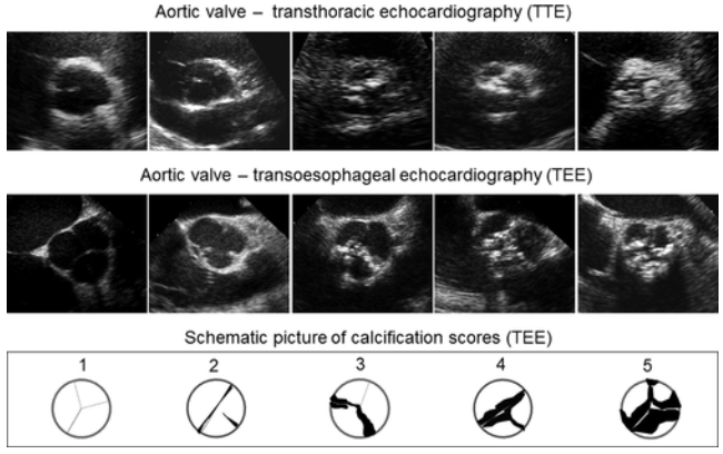<p>Assess aortic valve structure, function, and stenosis severity</p><p>Assess LV</p>