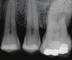 <p>What is wrong with this premolar PA?***</p>