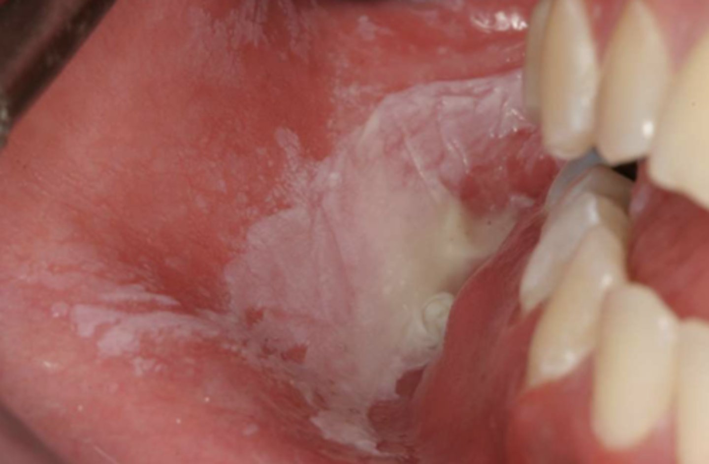 <p>Patient reports that a portion of his inner cheek has turned white over the past month. The lesion is asymptomatic. There are no changes to his medical history, but he noted that he has been trying out a new tooth whitening product. The patient isn't currently taking any medications. The white macule doesn't (*does) slough off upon clinical manipulation. What do you suspect?</p>