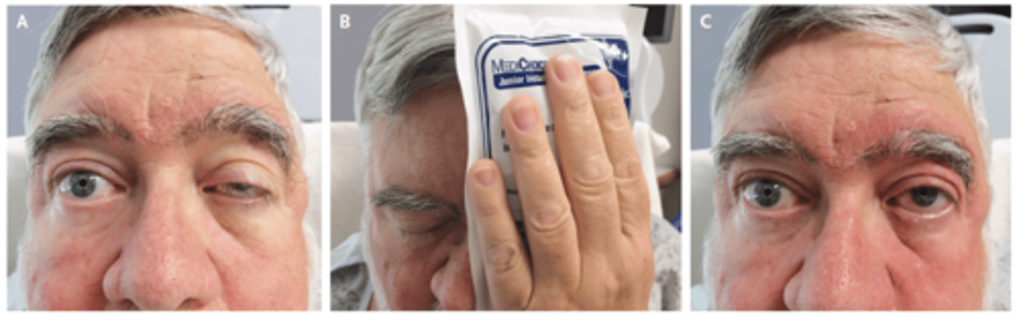 <p>Compression over ptosis with ice pack - test for myasthenia gravis. Positive if the ptosis improves</p>