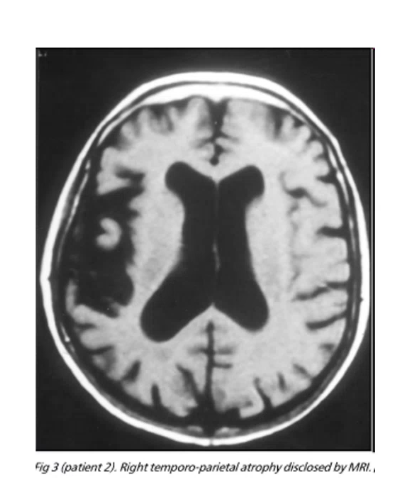 <p>lesion to ________ _____ lobe can cause alien hand syndrome where there hand acts on its own and patients are unable to control their hand, can also be caused by damage to _____ ______</p>