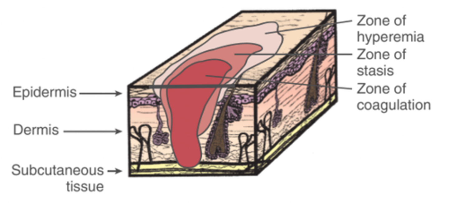 <p>area of less severe injury that possesses reversible damage (may die in 24-48hrs without diligent treatment) and surrounds the zone of coagulation</p>