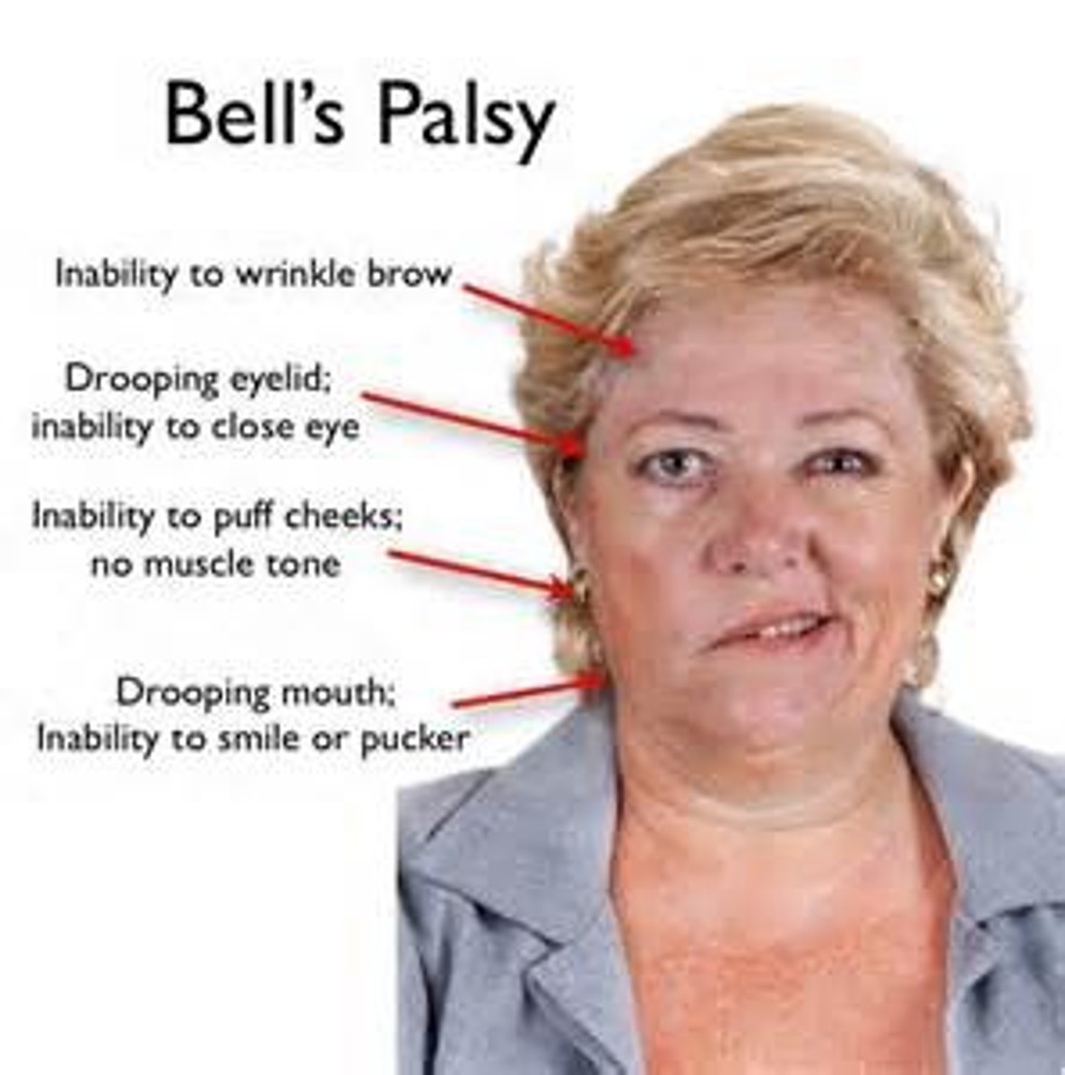 <p>Type of mononeuropathy of CN VII leading to an abrupt onset of unilateral upper &amp; lower facial weakness/paralysis; likely due to latent HSV 1 reactivation</p>