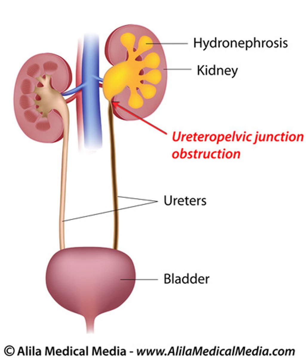 <p>Unilateral, hydronephrosis, most common obstruction location</p>