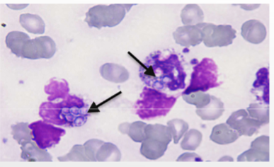 <p>Histoplasmosis&nbsp;</p>