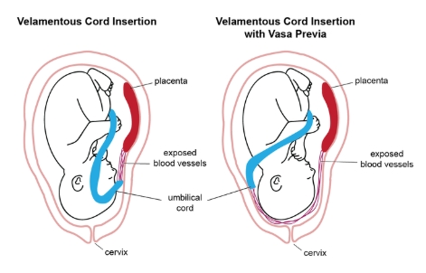 <p>what delivery complication is most commonly assoc w/<strong>velamentous cord</strong> insertion</p><p>.</p><p>a) meconium peritonitis</p><p>b) vasa previa</p><p>c) fetal respiratory distress</p><p>d) premature rupture of membranes</p>