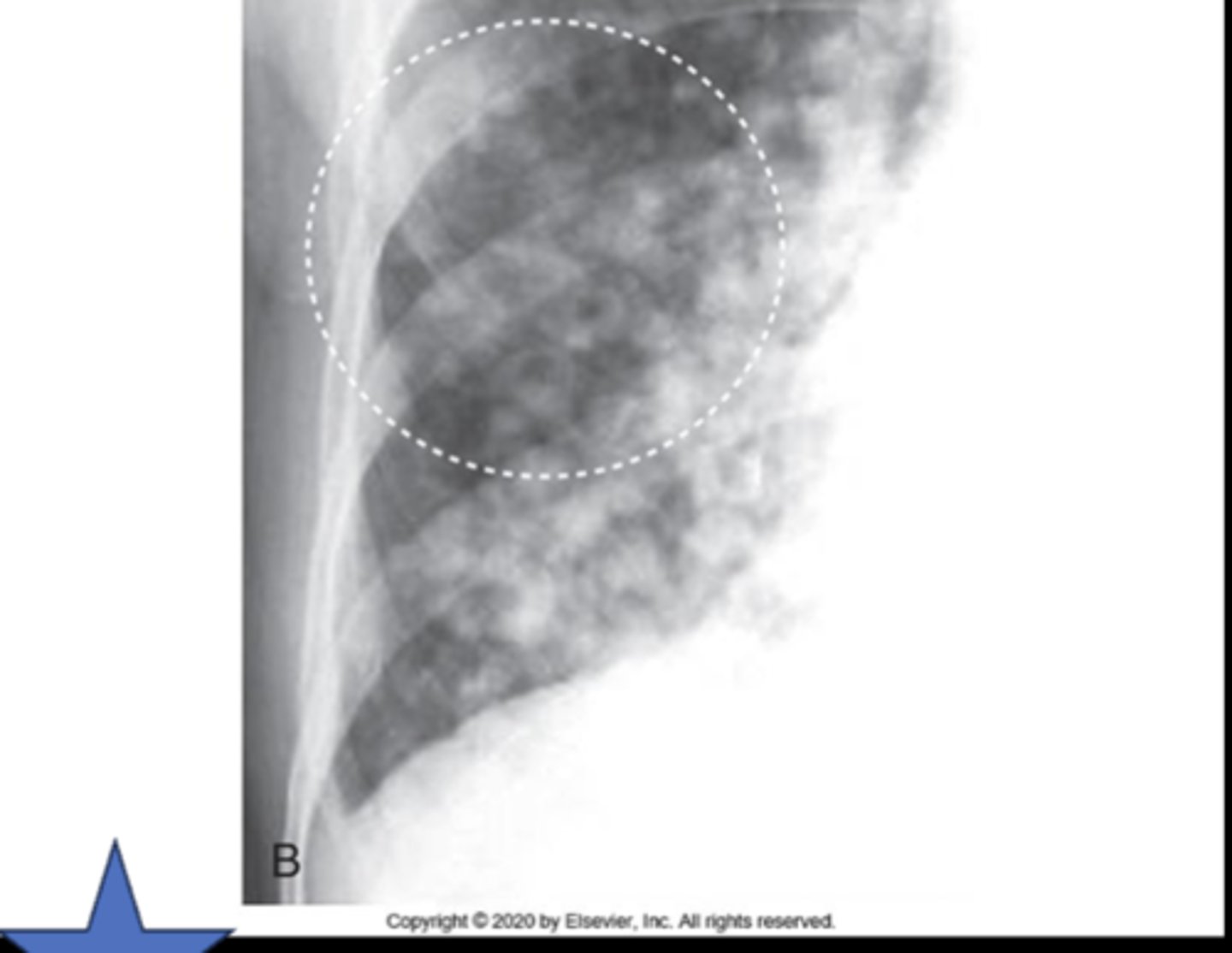 <p>What type of density can be seen in this image?</p>