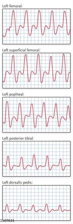 <ol><li><p>What kind of waveforms are seen here?</p></li><li><p>If this was taken on a CW doppler exam, is the waveform normal or abnormal? </p></li></ol><p></p>