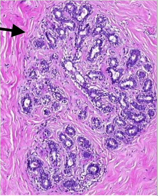 <p>Welke vorm fibroadenoom van de borstklier</p>