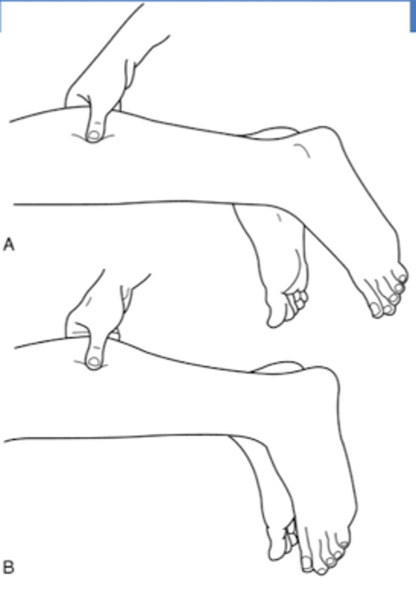 <p>(+) Thompson test</p><p>Not able to stand on tip toes on affected side</p>