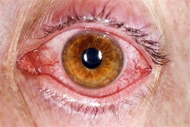 <p>= infection of the conjunctiva (“pink eye”)</p><ul><li><p>red beefy looking vessels @ periphery</p></li><li><p>common from viral or bacterial infections, allergy, or chemical irritant</p></li></ul>