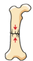 <p>Type of fracture? </p>