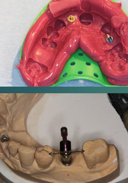 <p>What is the first step to fabricating a provisional implant restoration?</p>