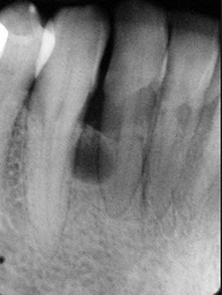 <p>ID the cyst (tooth is vital)</p>