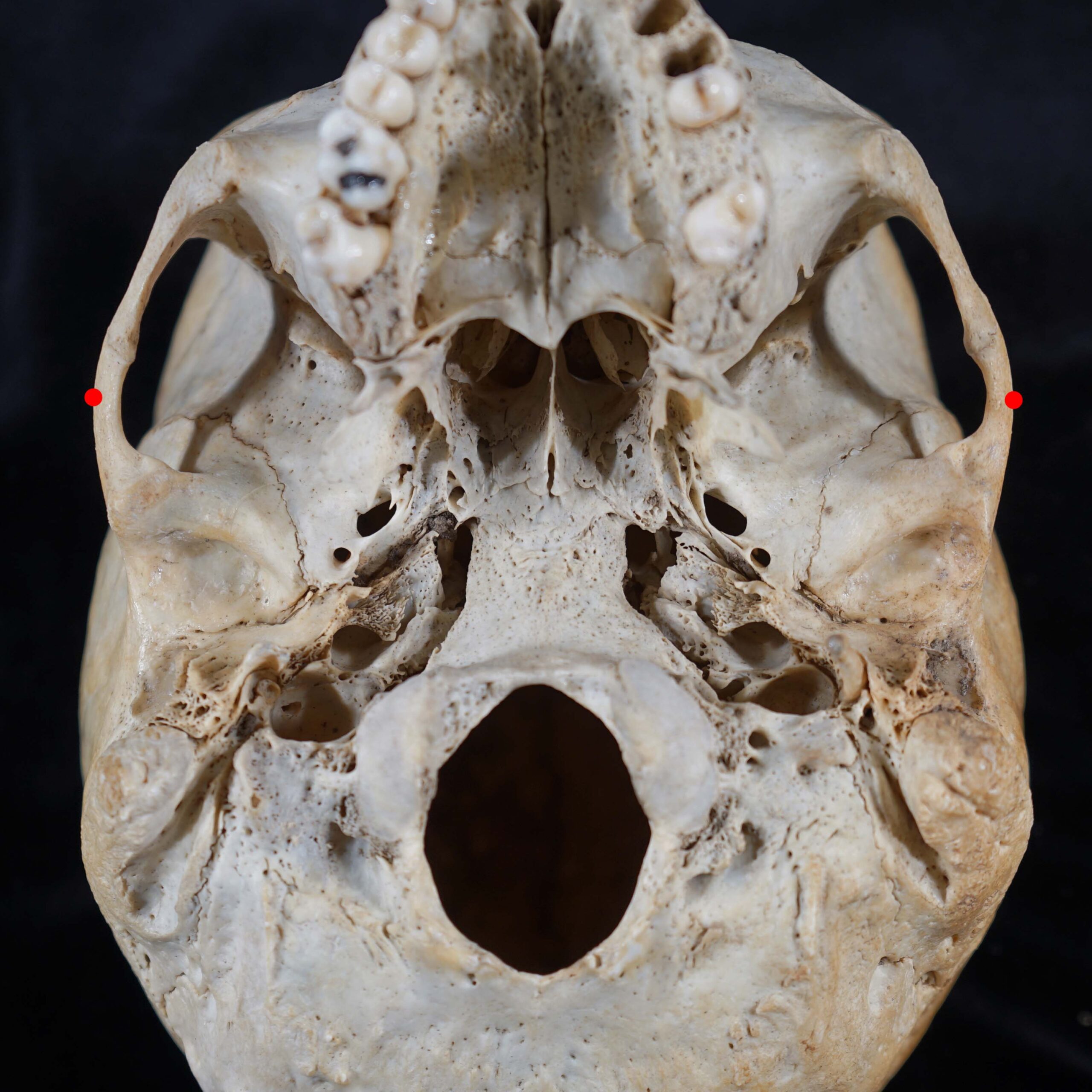 <p>Maximum lateral extent of lateral zygomatic arch</p>