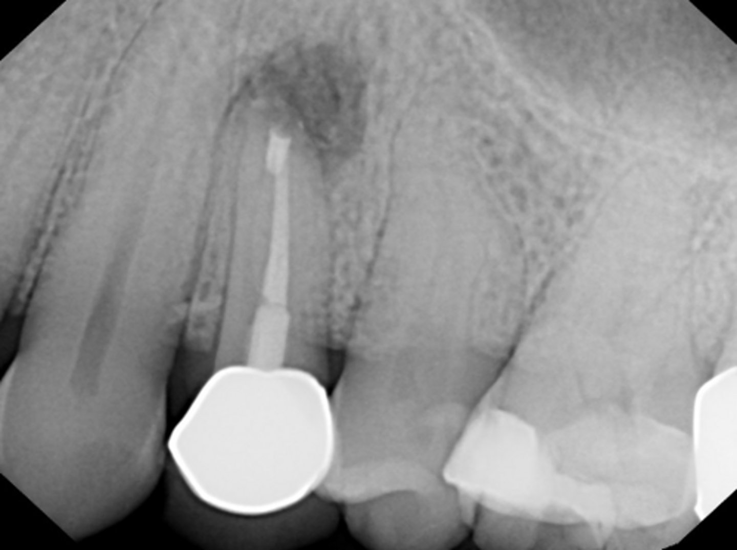 <p>ID the reason for RC failure:</p><p>- Host defenses cannot eliminate true cysts</p><p>- Extraradicular microorganisms may form colonies and establish biofilms</p><p>- - Actinomycosis (sulphur granules)</p>