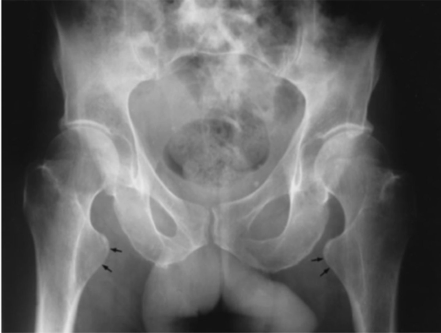 <p>Which femur rotation was present for this projection</p>