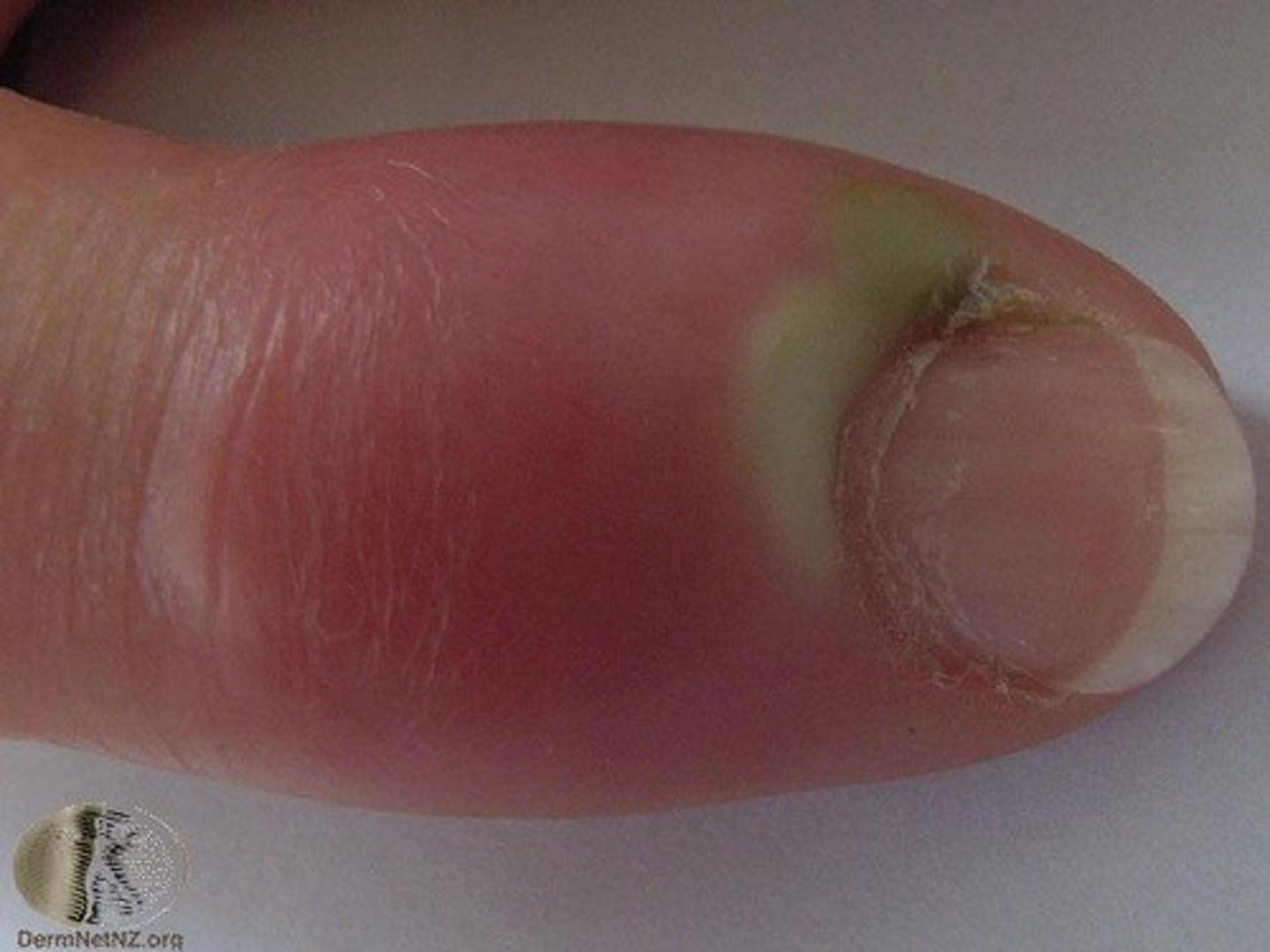 <p>PE:</p><p>Erythema, warmth, and edema of affected area</p><p>Will not be bilateral and will blanch on palpation</p><p>Possible lymphangitis</p>