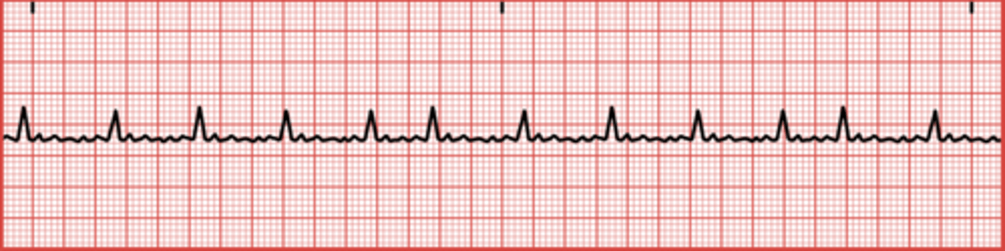 <p>It can lead to ineffective pumping of the heart and increase the risk of blood clots.</p>