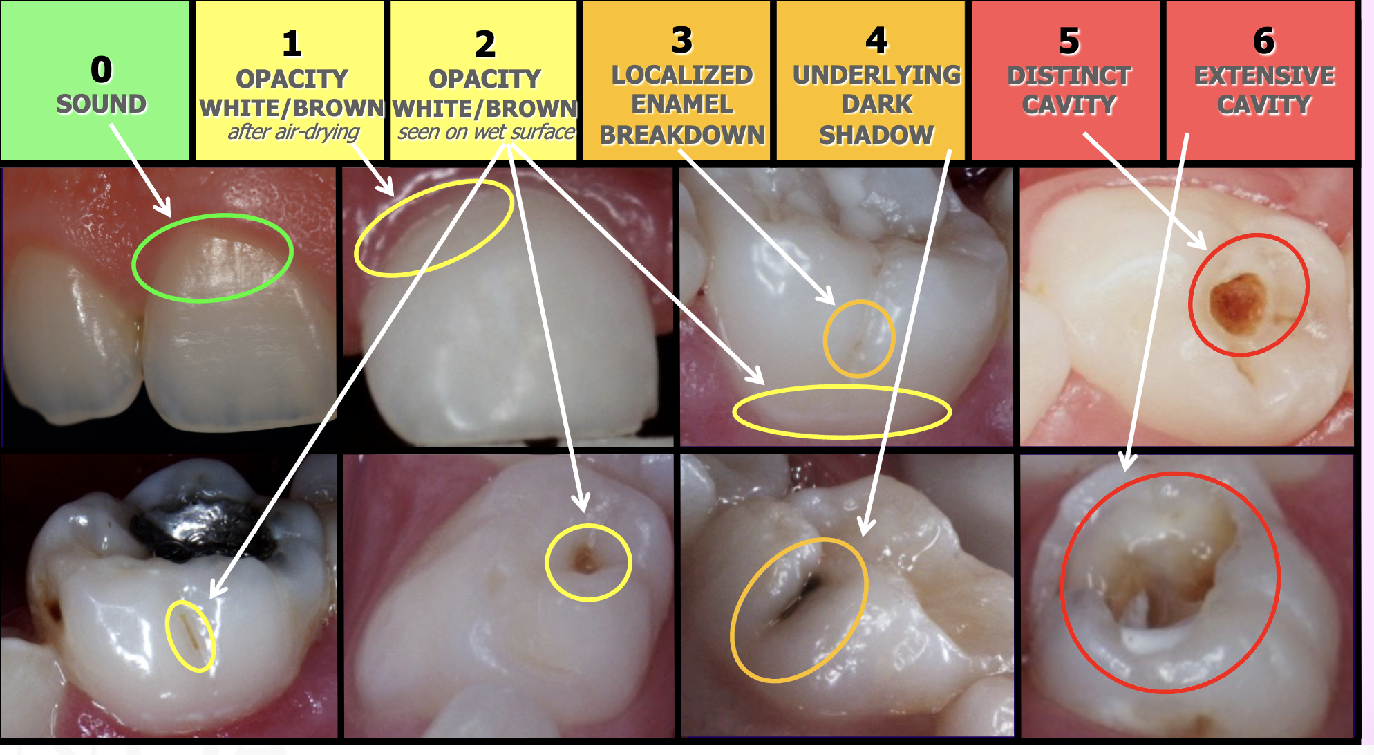 <p><span style="background-color: transparent;"><span>Mandibular Canine, 5</span></span></p>
