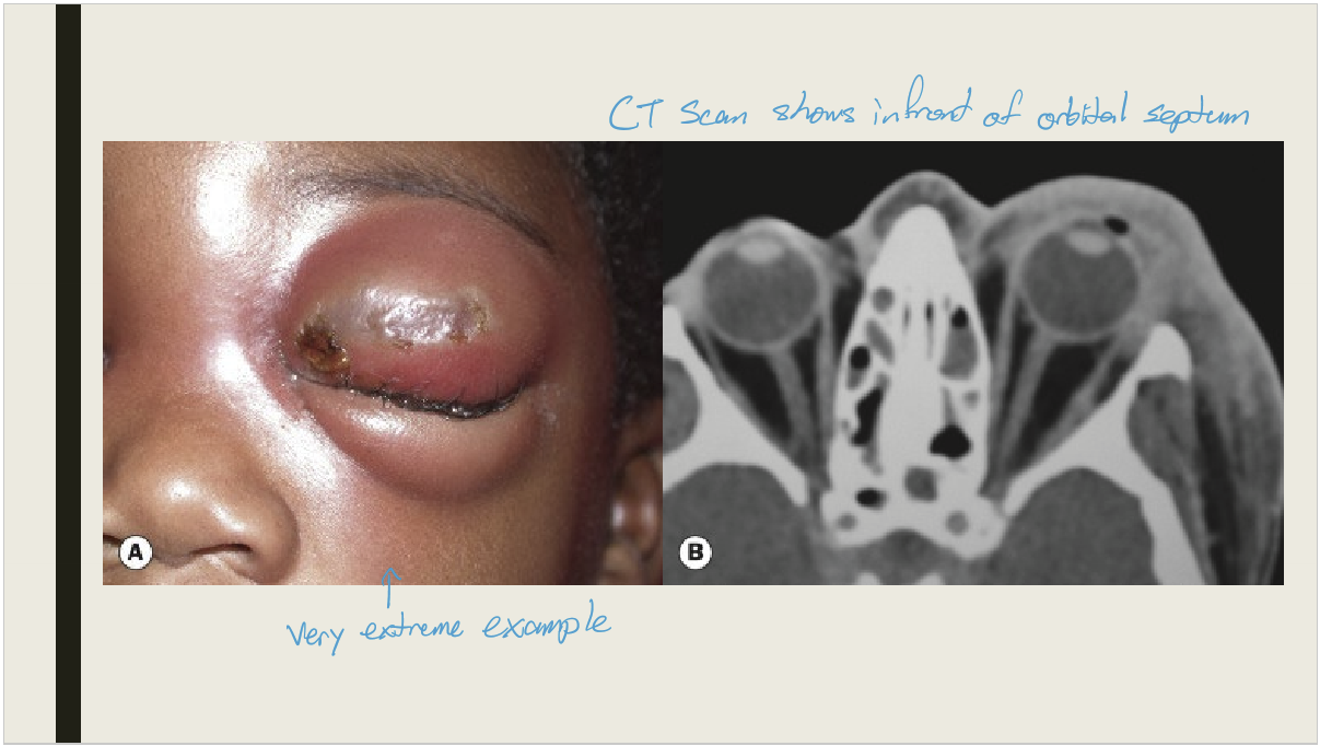 <p>Preseptal cellulitis, an infection of the subcutaneous tissue anterior to the orbial septum </p>