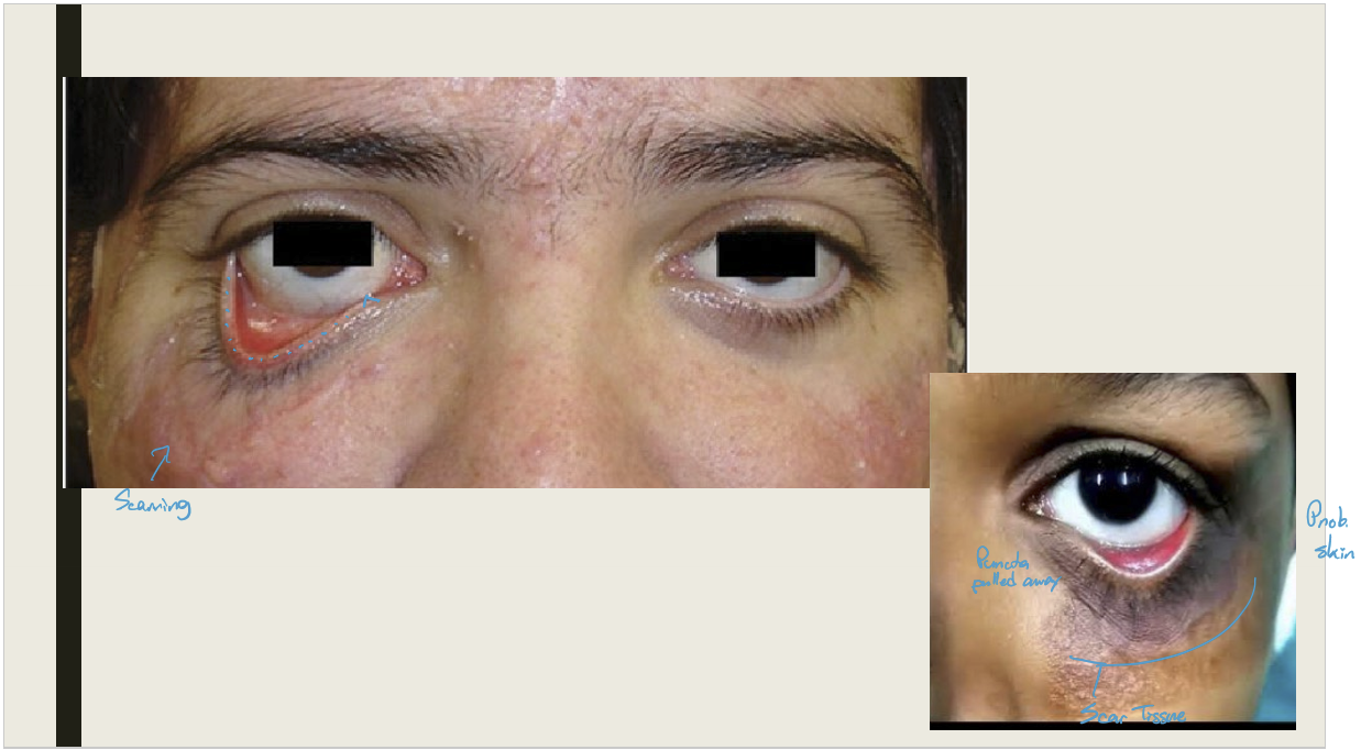 <p>Scarring or contracture of the skin and underlaying tissues that pulls the eyelid away from the globe</p>