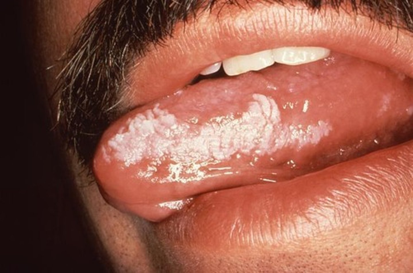 <p>white lesion that cannot be rubbed off and cannot be diagnosed through clinical characteristics alone</p>