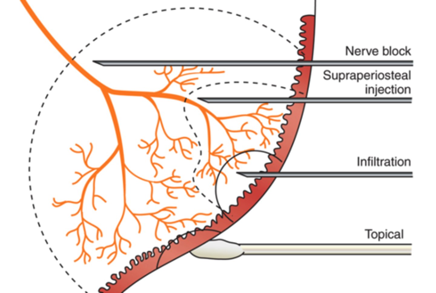 <p>"field block"</p><p>• regional anesthesia near large terminal nerve branch</p><p>• provides pulpal + soft tissue anesthesia of single tooth</p>