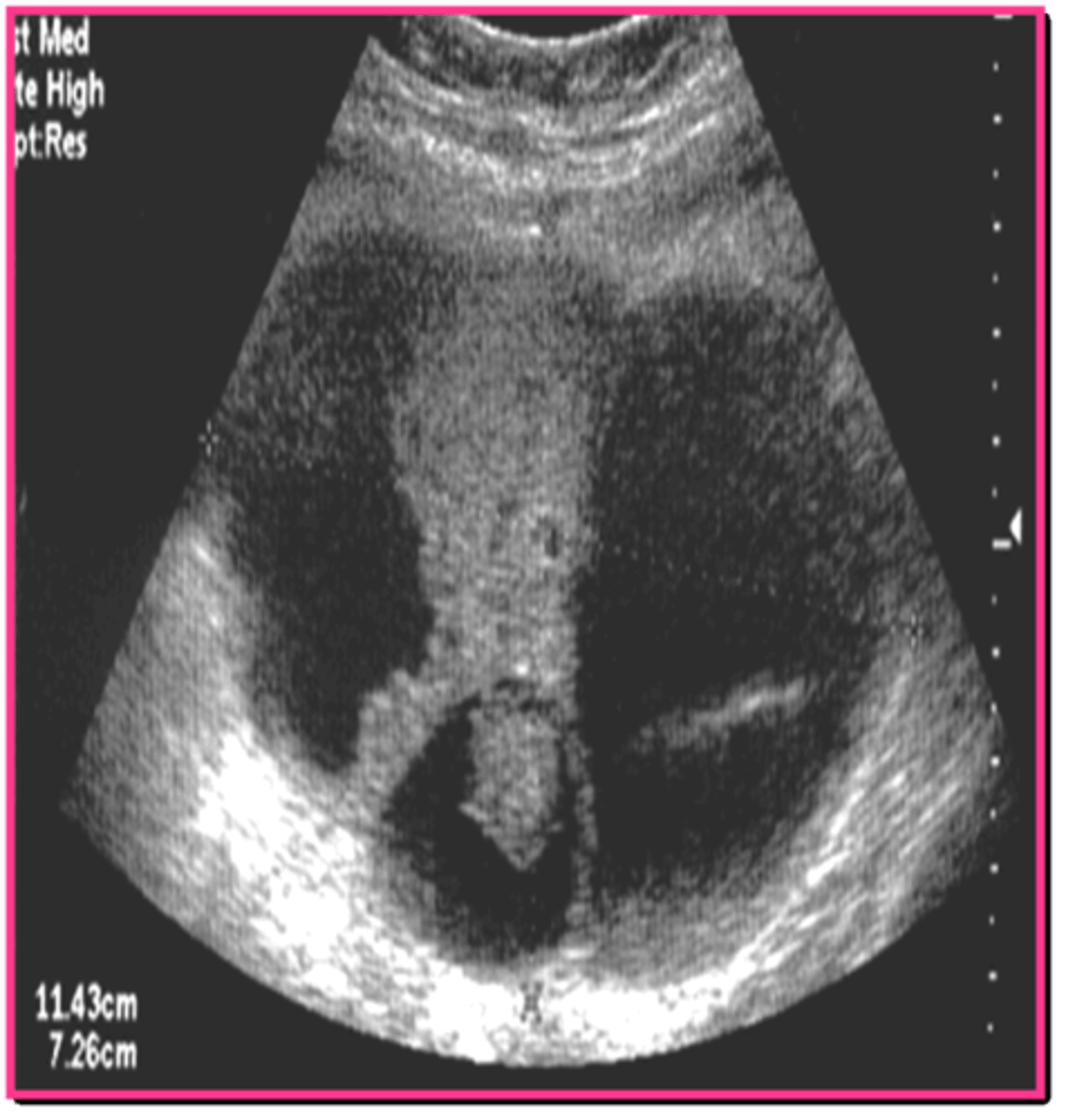 <p>loculated ascites</p>