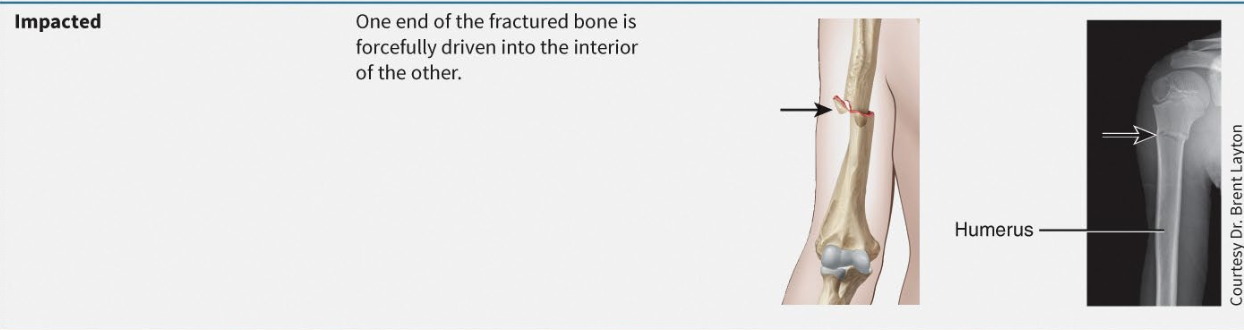 <p>One part is shoved up into another</p>