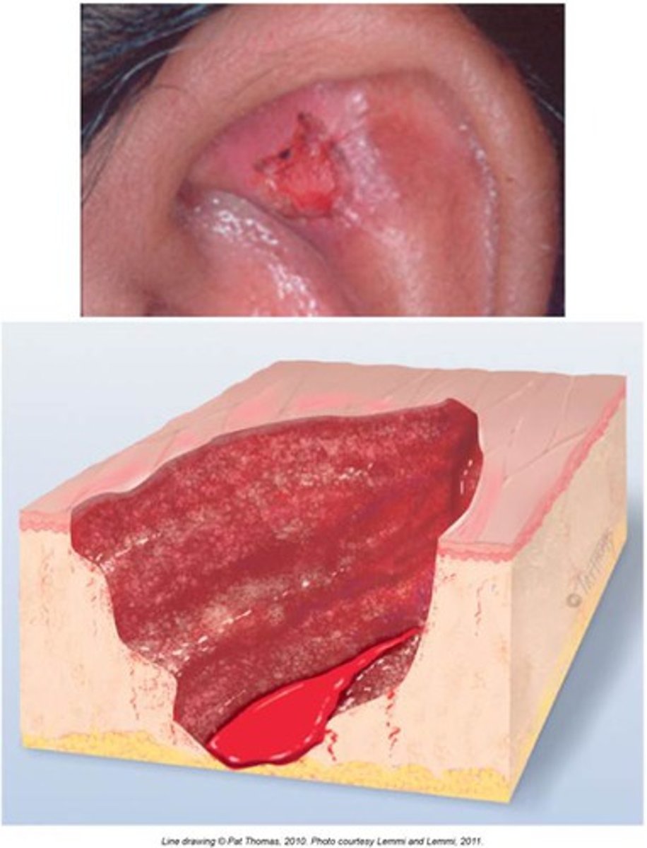 <p>depression extending into dermis, irregular borders, and may bleed</p>