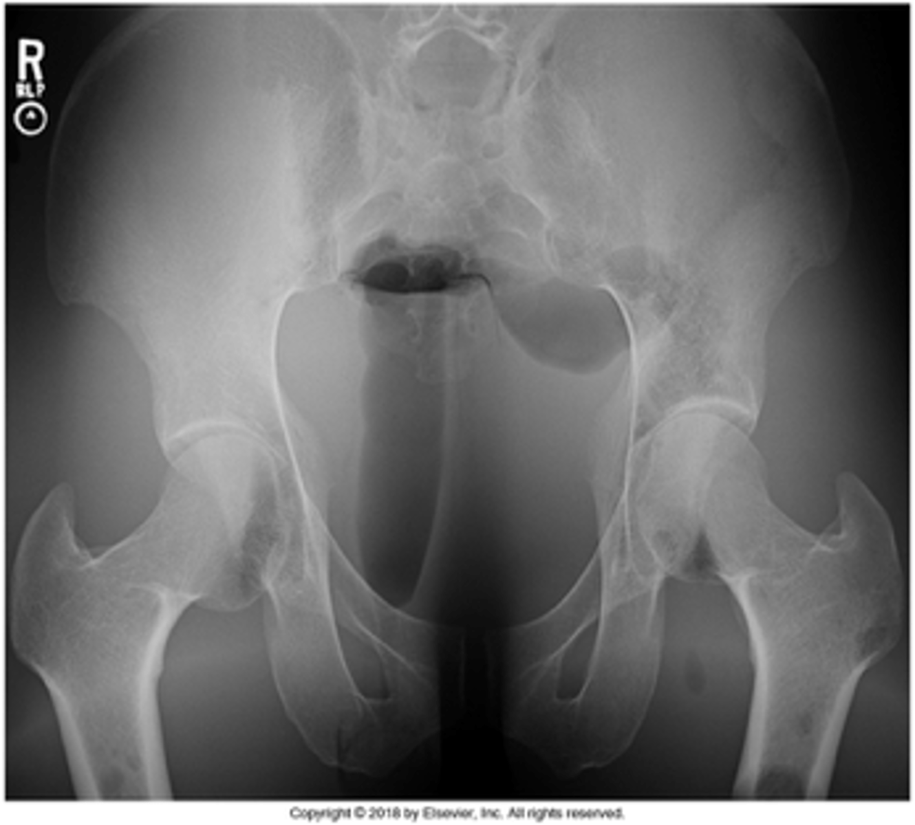 <p>- CR 40° caudad at level of ASIS</p><p>- Ischial spines demonstrated and equal</p><p>- Pelvic inlet centered</p><p>- Lateral collimation evident</p><p>- Optimal exposure factors</p>