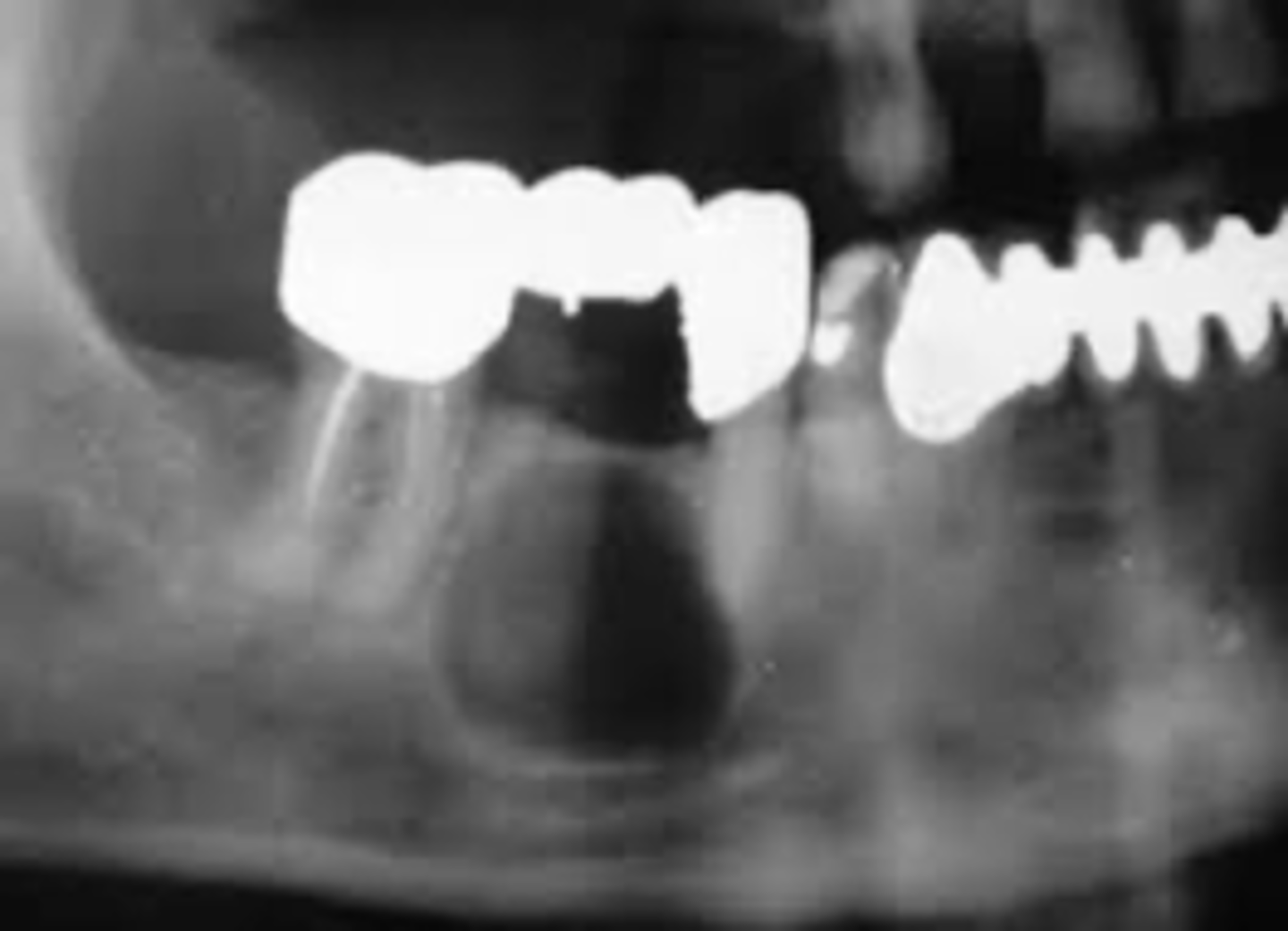 <p>Above IAN canal</p>