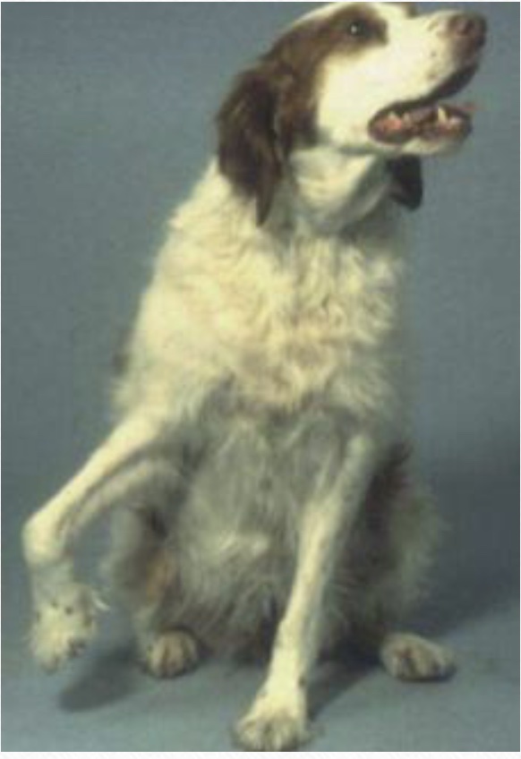 gait disorder: infraspinatus contracture