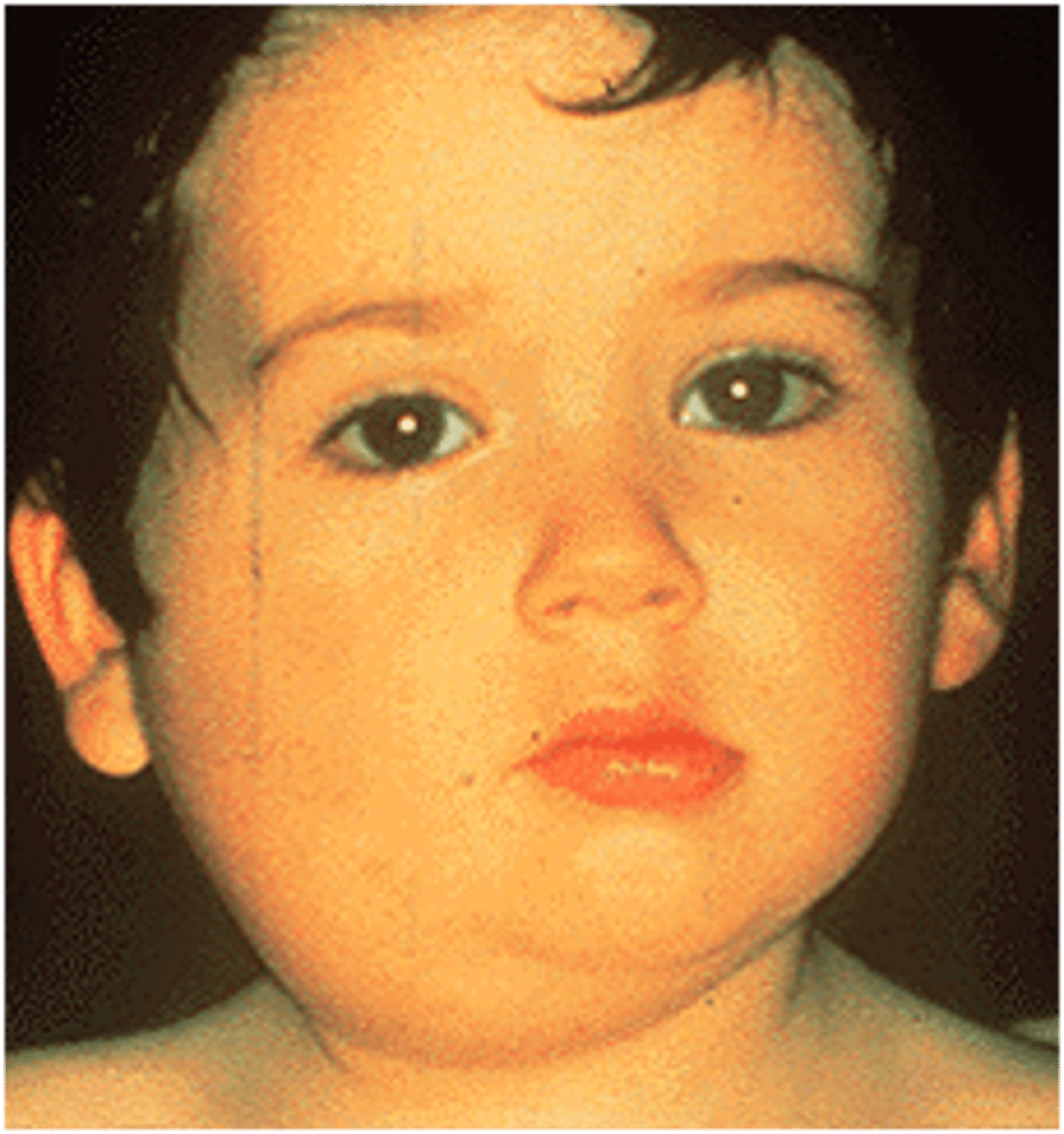 <p>Parotid</p>