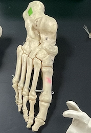 <p>Bone on foot?</p>
