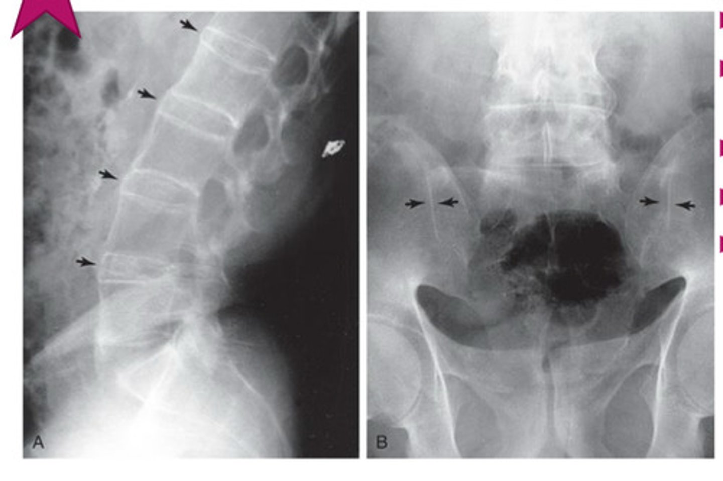 <p>young, males</p><p>neck/LBP, worse @ night &amp; better w/ exercise</p>