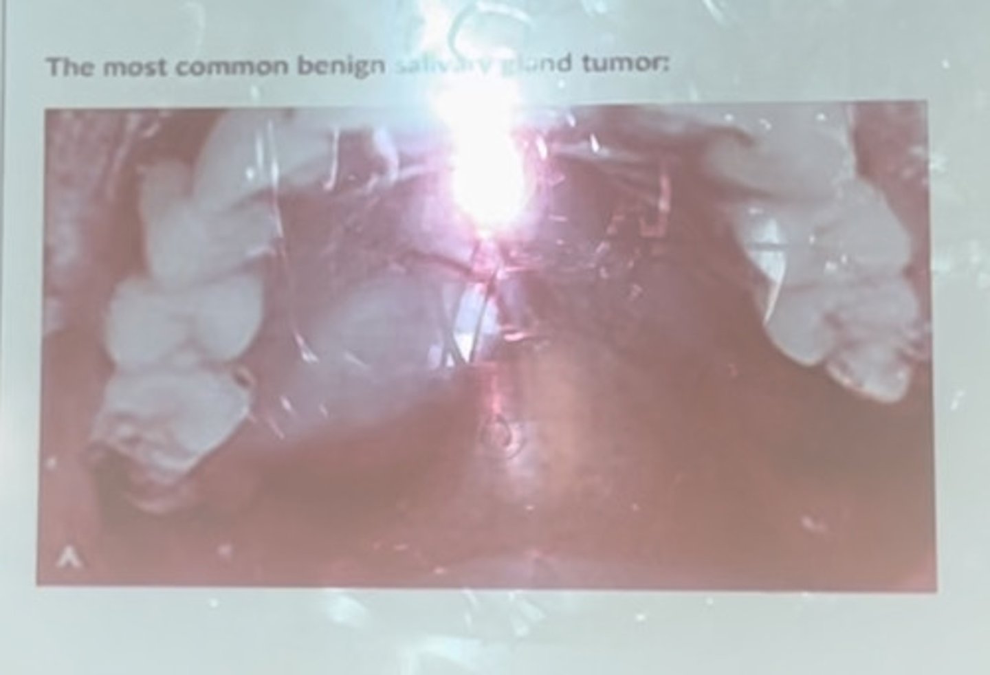 <p>The most common benign salivary gland tumor</p>