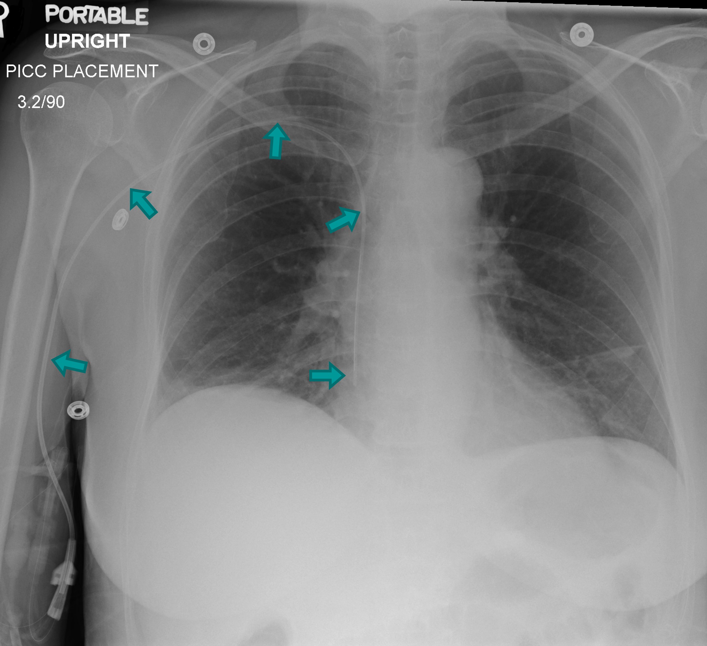 <p>What are the advantages of PICCs?</p>