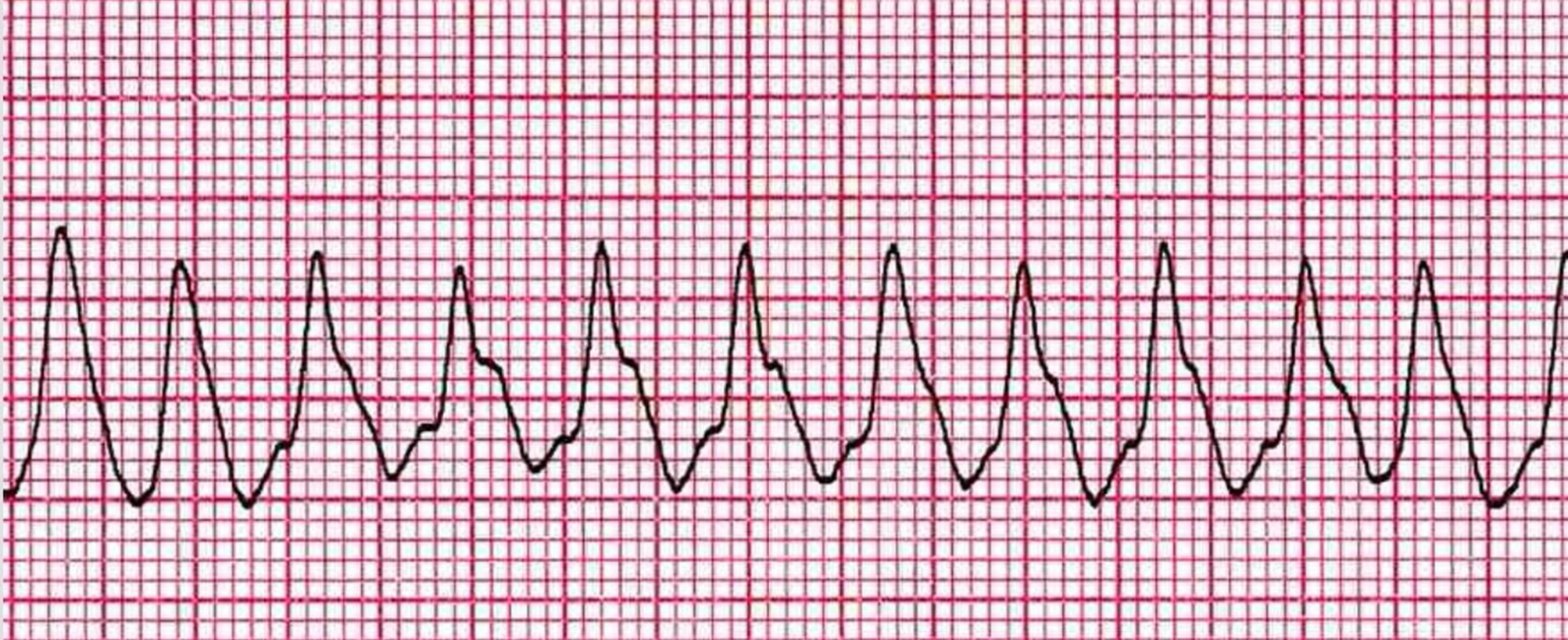 <p>EKG</p>