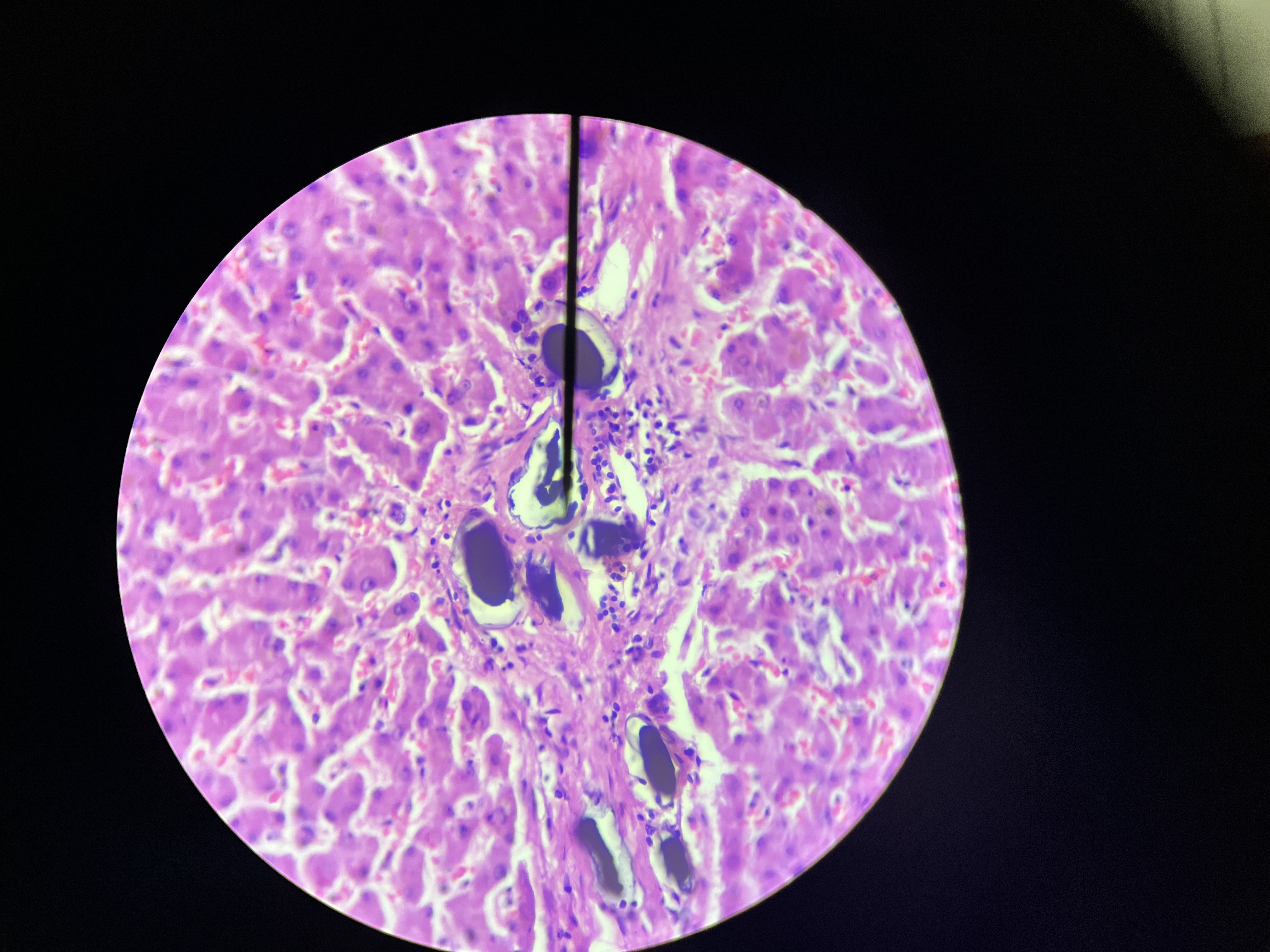 <p>A parasitic infection caused by trematodes of the Schistosoma genus, leading to liver damage and portal hypertension. </p>