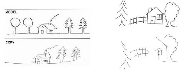 <ul><li><p>Some patients may demonstrate impairments in line bisection but not cancellation and vice-versa.</p></li><li><p>Neglect as a syndrome rather than an indiv cond.</p></li></ul><p></p>