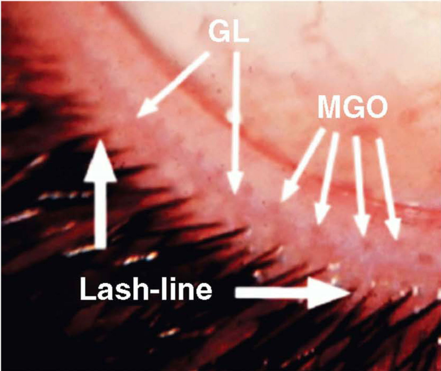 <p>1- grey line 2- Meibomian gland orifices 3- lash line</p>