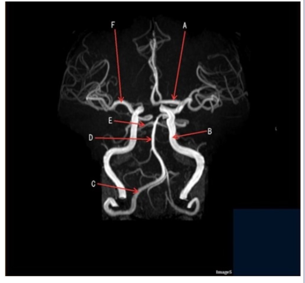 <p><span><strong>Image 5 is an example of an:</strong></span></p><p><span>&nbsp;A. MRI brain</span></p><p><span>&nbsp;B. MRV sagittal sinus</span></p><p><span>&nbsp;C. MRS single voxel</span></p><p><span>&nbsp;D. MRA Circle of Willis</span></p>