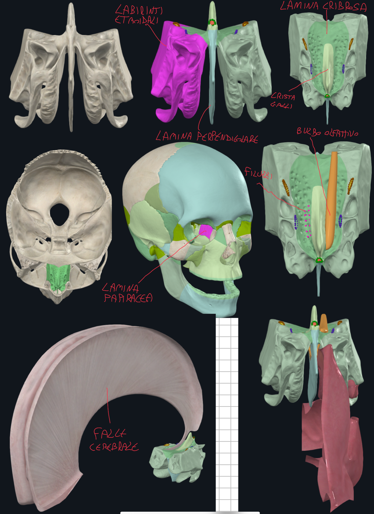 <p>Caratteristiche:</p><ul><li><p>Osso impari e mediano</p></li><li><p>Localizzato alla base del cranio</p></li></ul><p>Formato da:</p><ul><li><p>Lamina Orizzontale (o Cribrosa):</p><ul><li><p>forma il tetto della cavità nasale e il pavimento della fossa cranica anteriore</p></li><li><p>cribrosa perché presenta numerosi fori attraversati da filuzzi del nervo olfattivo che dalla mucosa nasale vanno al bulbo olfattivo</p></li><li><p>al centro di essa di solleva la Crista Galli → punto di inserzione per la falce cerebrale</p></li></ul></li><li><p>Lamina Perpendicolare:</p><ul><li><p>si prolunga in alto dalla cribrosa → partecipa a formare la crista galli</p></li><li><p>si prolunga in basso → costituisce parte superiore del setto nasale osseo dividendo le due cavità nasali</p></li></ul></li><li><p>Labirinti Etmoidali</p><ul><li><p>ai lati della lamina perpendicolare</p></li><li><p>masse laterali che costituiscono la parete laterale della cavità nasale e partecipano a formare la parete mediale dell’orbita (attraverso la lamina papiracea, molto sottile)</p></li><li><p>al loro interno contengono cellule etmoidali, delle cavità aeree, i seni paranasali </p></li></ul></li></ul><p></p>